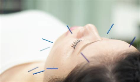 Acupuncture London .